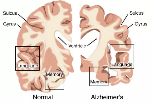 AD药物研发现状：辉瑞、礼来、百健、诺华、强生……