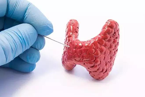 甲状腺疾。鬃聪俟δ芗跬撕图鬃聪俟δ芸航，自古以来就是反复被医学研究人员研究的疾病