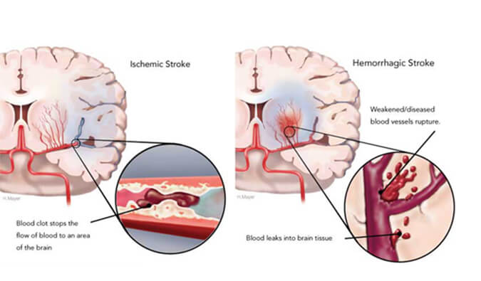 世界卒中日：从动物药效模型评价看心脑血管药物开发